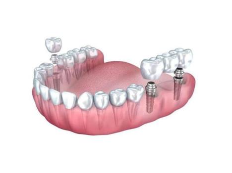 روش زیبایی و ترمیم دندان