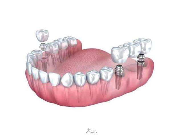 روش زیبایی و ترمیم دندان