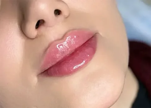 همه چیز درباره تزریق فیلر لب